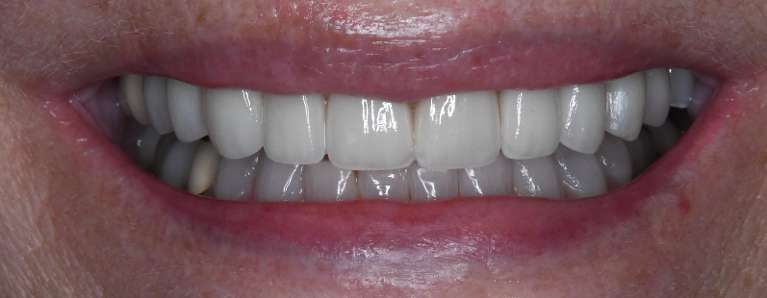 Teeth-Whitening-Porcelain-Crowns-Dental-Implants-and-Implant-Crowns-After-Image