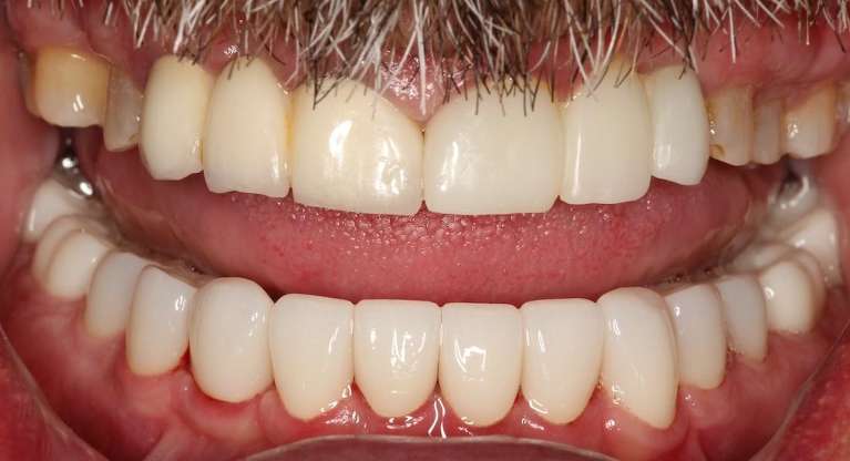 porcelain crowns used to improve worn bottom teeth, tuscaloosa al