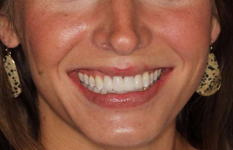 new ceramic crowns used to improve this patient's old crowns