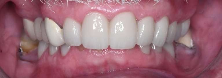 Close up of mans teeth with mustache after porcelain crowns, tuscaloosa al