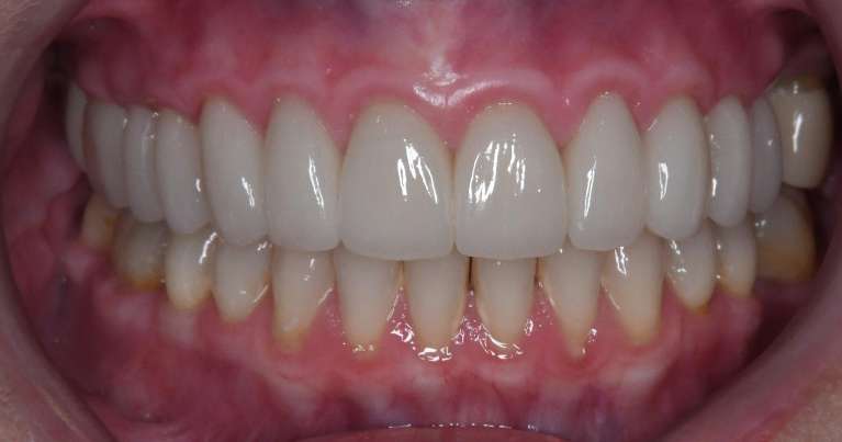 Close up of womens teeth after porcelain crowns, tuscaloosa al