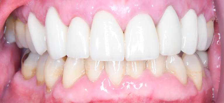 Close up of teeth after Teeth Whitening, Porcelains Crowns, and Porcelain Bridge, tuscaloosa al