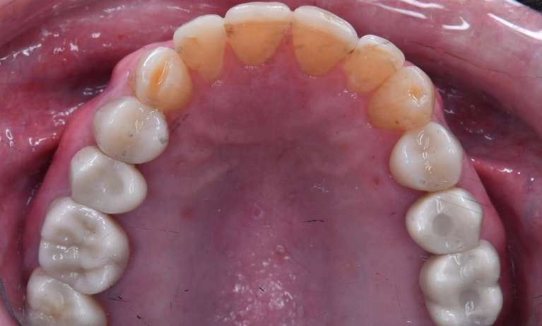Overhead view of mouth after extensive dental work, tuscaloosa al