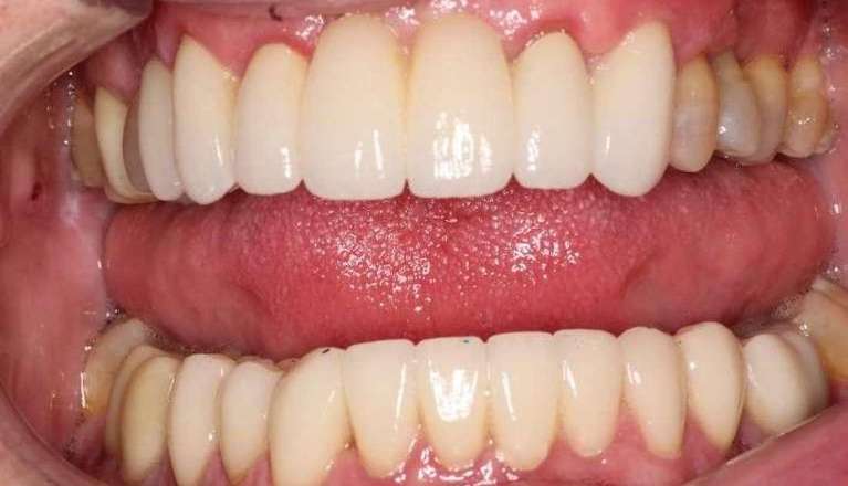 patient's smile after porcelain bridge used