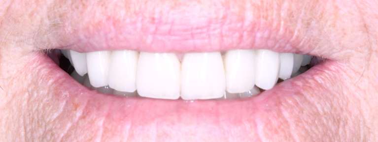 Mouth after Teeth Whitening, Porcelains Crowns, and Porcelain Bridge, tuscaloosa al