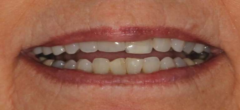 oddly shaped front teeth