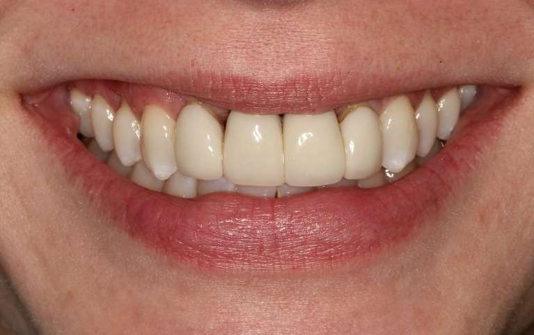 old dental crowns