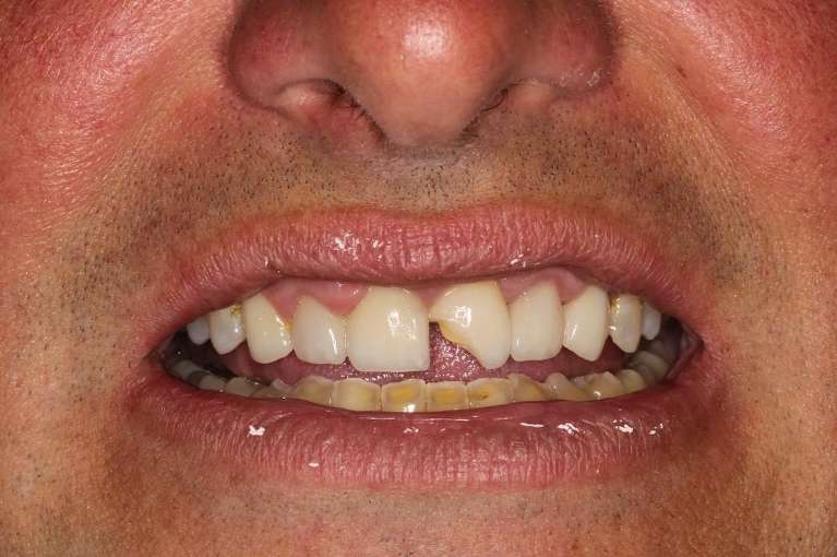Chipped front tooth