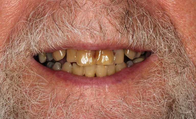 Close of man's decayed and stained teeth