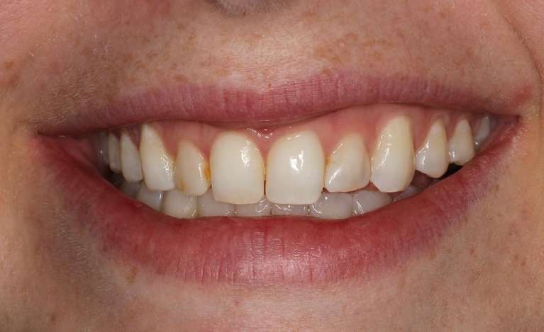 discolored front teeth