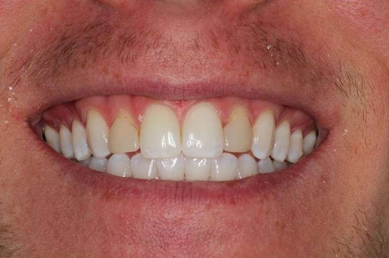 discolored top arch teeth
