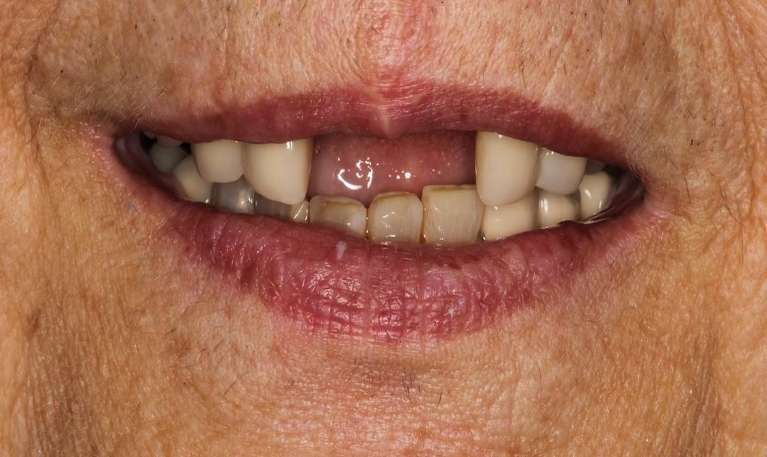 missing front teeth
