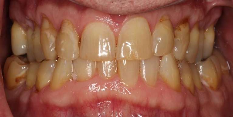 Decayed and discolored upper and lower teeth