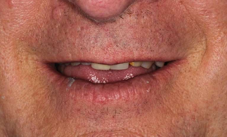 missing and compromised front teeth