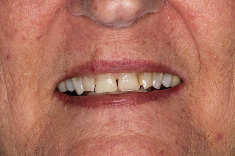 misshapen front teeth of patient