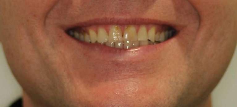 close up of man's smile before crowns and veneers, tuscaloosa al