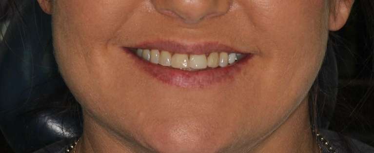 stained teeth
