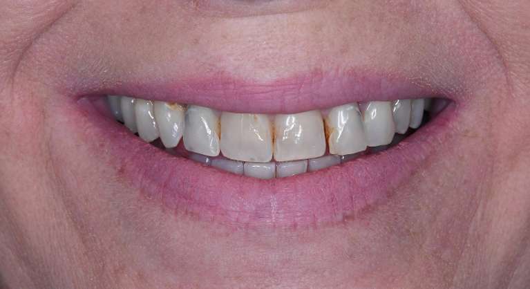Womens mouth before porcelain crowns, tuscaloosa al