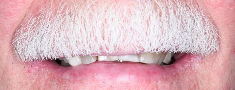 Close up of mans mouth with mustache before porcelain crowns, tuscaloosa al