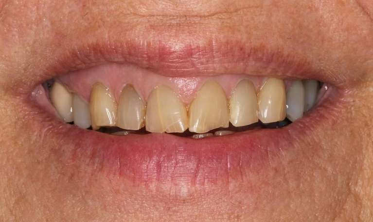 Discolored front teeth
