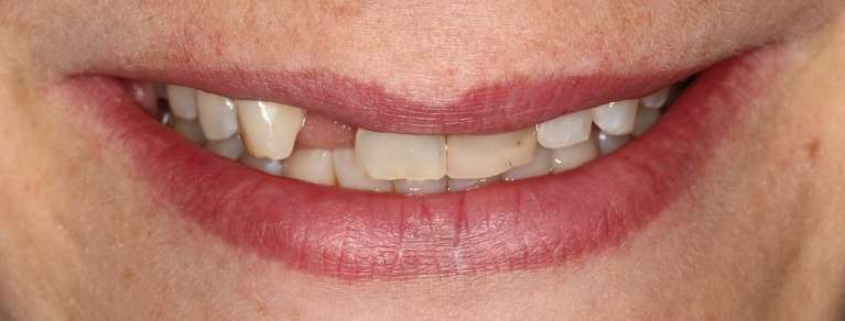 Smile with missing and broken teeth