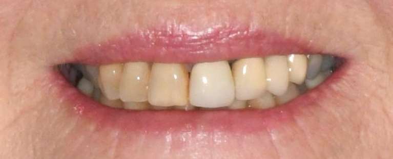 Mouth before Teeth Whitening, Porcelains Crowns, and Porcelain Bridge, tuscaloosa al