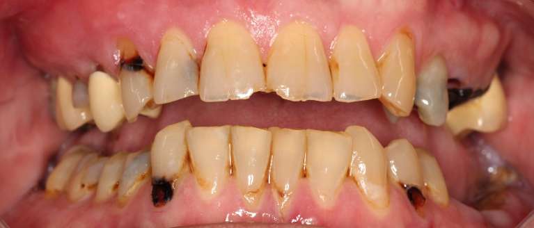 Teeth-Whitening-with-bonded-fillings-porcelain-crowns-dental-implants-and-implant-crowns-Before-Image