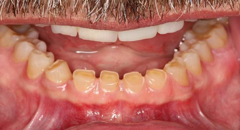worn bottom teeth before porcelain crowns, tuscaloosa al