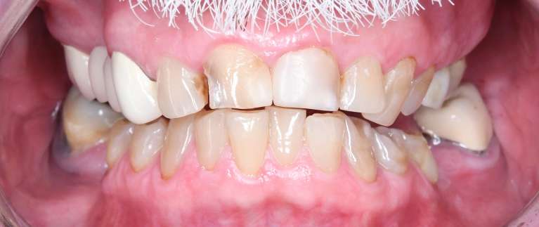 Close up of mans teeth with mustache before porcelain crowns, tuscaloosa al