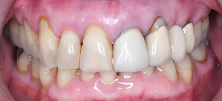 Close up of teeth before Teeth Whitening, Porcelains Crowns, and Porcelain Bridge, tuscaloosa al