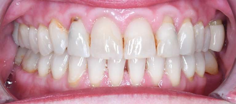 Close up of womens teeth before porcelain crowns, tuscaloosa al