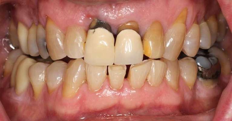 missing and compromised front teeth